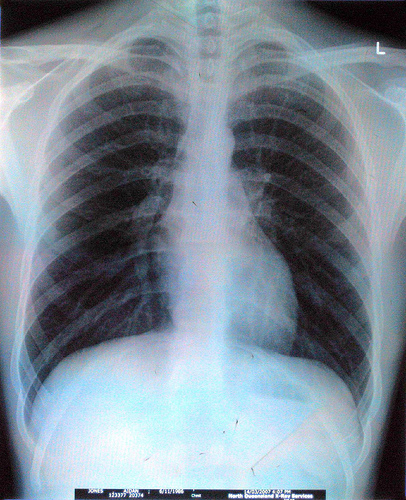 Fitxer:Chest X-Ray - Science Wiki.jpg