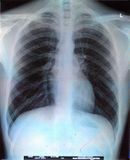 An X-Ray picture of the Human Body, more specifically, the rib cage.