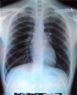 Radiographie poumons.jpg